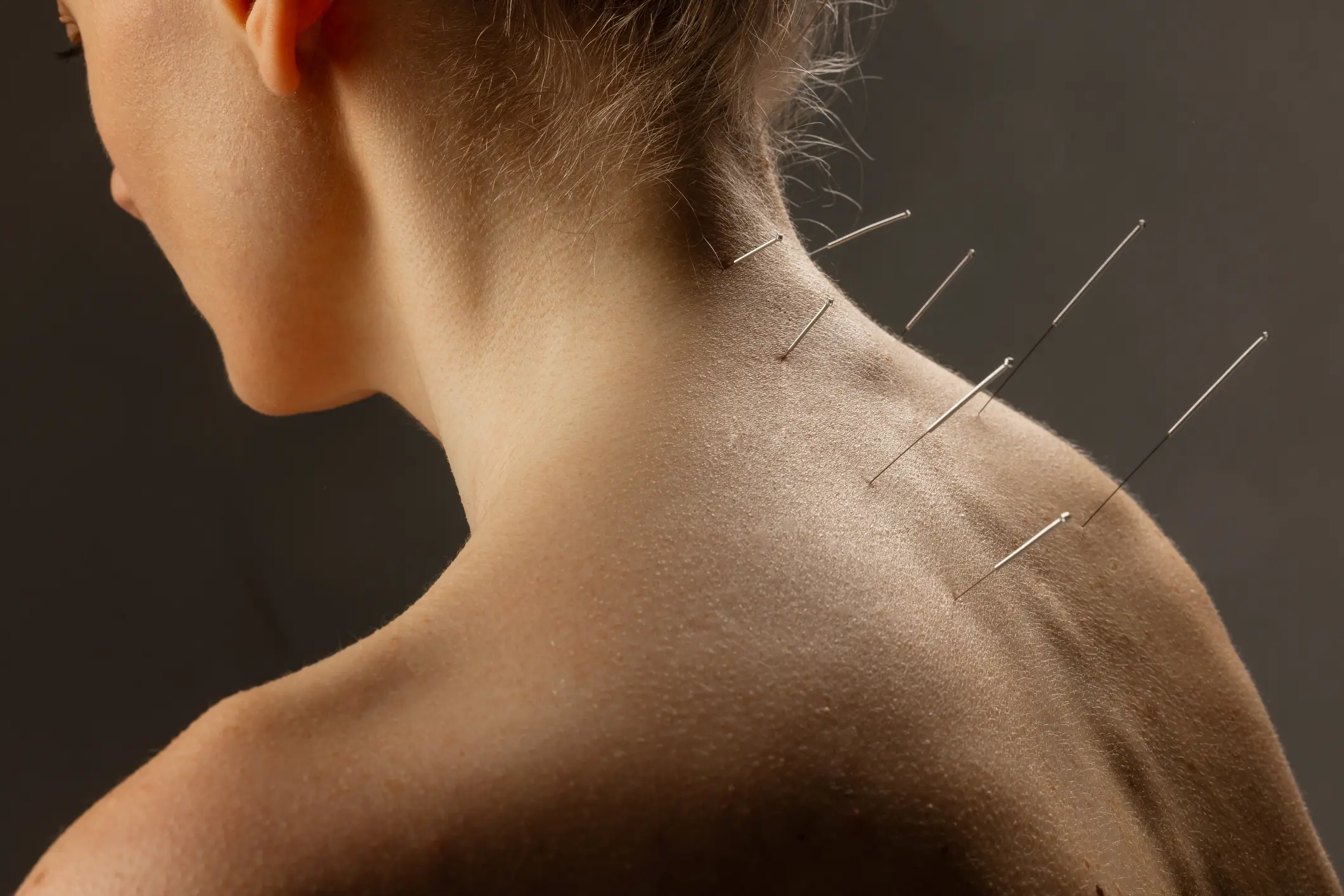 Woman receiving acupuncture on her back, with several needles inserted into her skin