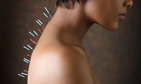 acupuncture on woman's back Acupuncture needles on Woman's Upper Back