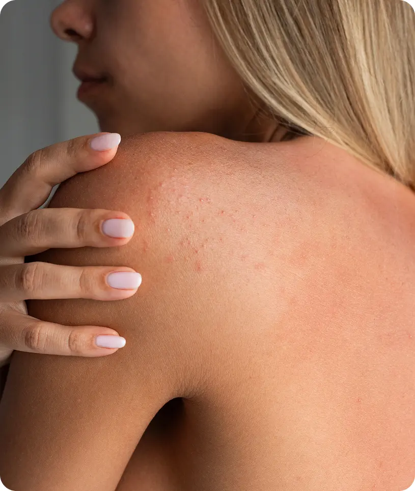 Woman with acne on her back, likely caused by a skin cancer treatment