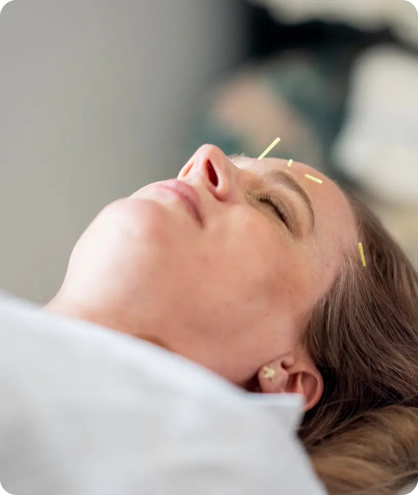 Woman lying on a bed with several needles placed on her forehead, likely for an acupuncture treatment