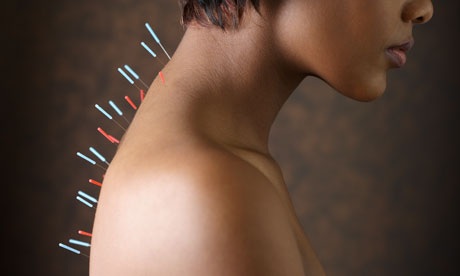 Acupuncture needles on Woman's Upper Back