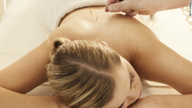 Woman receiving Acupuncture