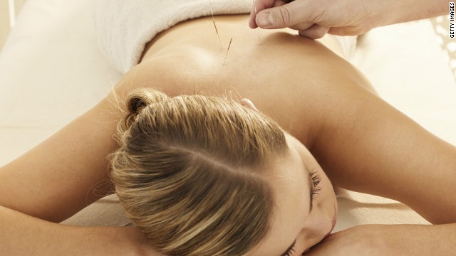 Woman Getting Acupuncture